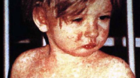 Decades after it was declared eliminated, I fear the heartbreaking, avoidable consequences of measles