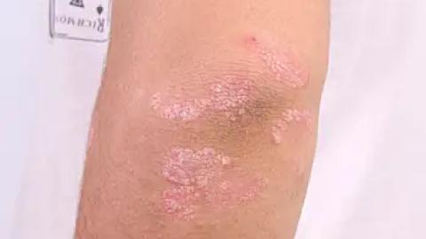 Health Canada Approves NDUVRA for the Topical Treatment of Plaque Psoriasis in Adults