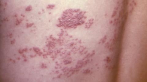 More evidence shingles vaccine lowers dementia risk