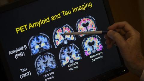 FDA OKs first blood test that can help diagnose Alzheimer's disease
