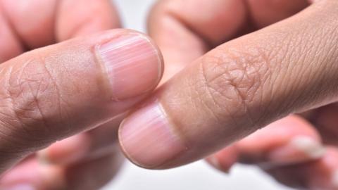 From thyroid issues to cancer, here's what your fingernails can tell you about your health