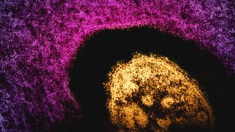 Measles cases are surging globally. Should children be vaccinated earlier?
