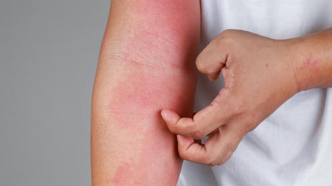 Study: Antibiotics during pregnancy, early childhood increase risk of chronic skin condition in kids