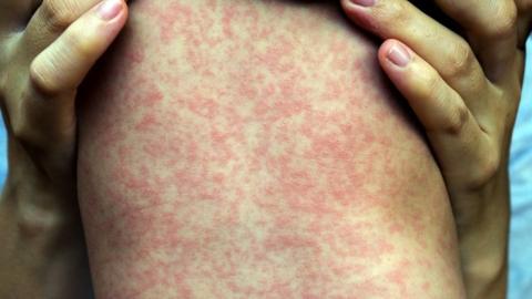 7 measles cases confirmed in Manitoba during 1st week of June
