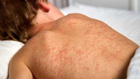 10 PEI infants need protective medication after potential measles exposures