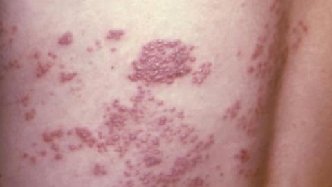 Study estimates 74% efficacy of shingles vaccine in patients over 50