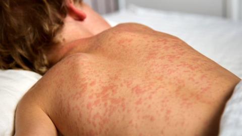 18 more measles cases, 4 new exposure sites confirmed in Manitoba
