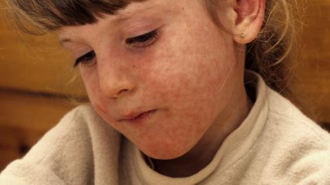Northeast B.C. measles outbreak to continue into 2026, health officials say