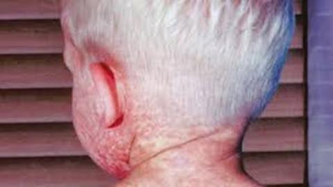 Alberta's measles outbreak topped 2,000 reported cases last year, and it's not over yet