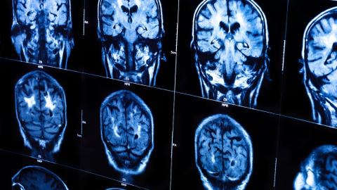 Women with traumatic brain injury 26 per cent less likely to receive trauma care than men, Ontario study finds