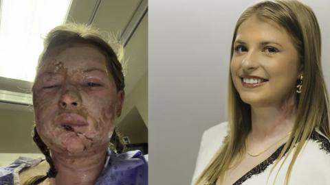 World-first burn treatment shows ‘remarkable’ results in Canadian patient