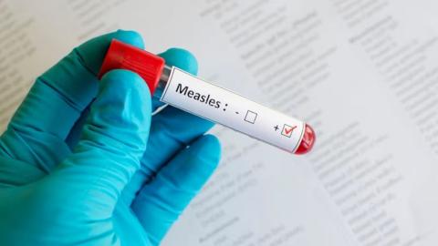 Members of the public may have been exposed to the measles at Pearson Airport, on 2 flights: health unit