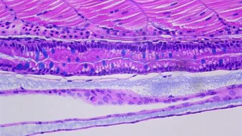 SickKids-led research uncovers new genetic cause of Crohn’s disease