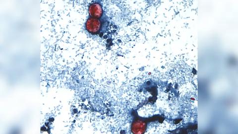 A diarrhea-causing parasite has infected more than 1,000 in the U.S. Is it in Canada?