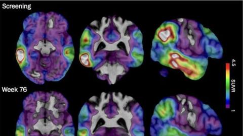 An experimental Alzheimer’s drug approved in U.S. shows some promise as researchers hunt new approaches
