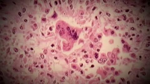 No new measles cases in N.B. after 1 identified in Moncton