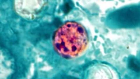 Cyclospora outbreaks causing diarrhea in US expected to continue through August