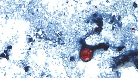 As cyclospora illnesses in U.S. surge to new record, Michigan officials eye lettuce as possible cause