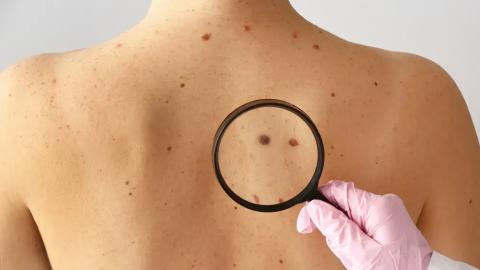 Experts urging people to use sunscreen as melanoma cases rise in Alberta