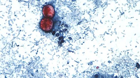 First deaths reported in cyclosporiasis outbreak
