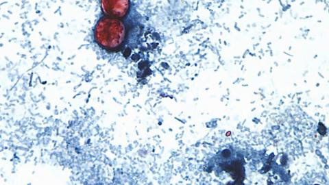 CDC expands largest known cyclospora outbreak to 15 states, Washington Post reports