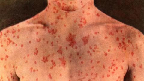 Canada’s measles cases are half of U.S. total, despite smaller population