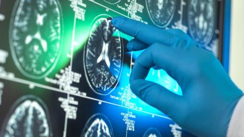 Alzheimer’s research is latest casualty in Trump administration war against ‘DEI’