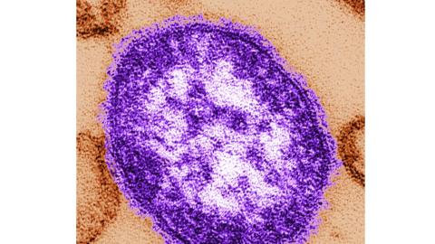 Trump’s new CDC director ordered delay in counting 2 measles-related deaths