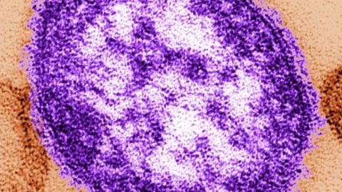 Pennsylvania says an unvaccinated woman has died from measles-related complications