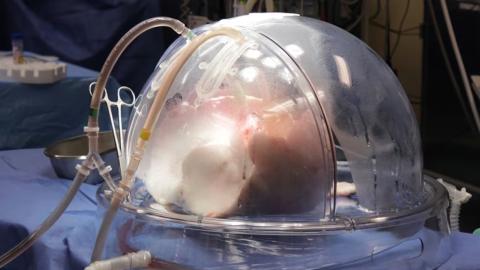 Toronto surgeon’s gene, stem cell therapy could make donor lungs ‘look more like itself’