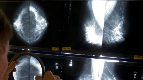 Breast cancer screening needs to be more consistent, accessible