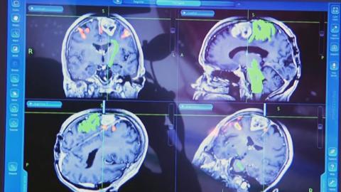 Chips, cereals and frozen meals could raise risk of brain damage and dementia, study finds