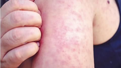 Canada’s 2-year measles outbreak officially over: PHAC