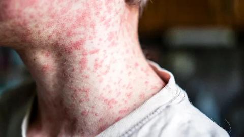 How Canada Can Prevent the Next Measles Outbreak