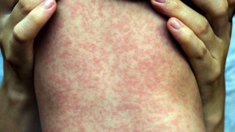 30 more measles cases confirmed in Manitoba, provincial health data shows