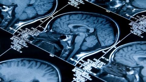 A new therapeutic approach developed by McMaster researchers could help prevent brain cancer. Here's how.
