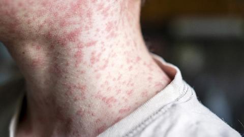 AHS alerts public to recent measles exposure at Calgary International Airport, Claresholm hospital