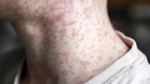 AHS warns of potential measles exposure at Wetaskiwin hospital