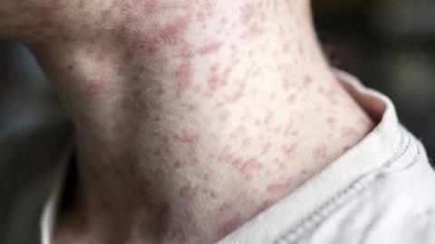 Alberta measles cases on the rise, as exposure at an Edmonton hospital prompts public alert