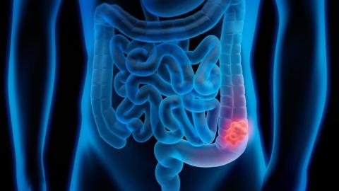 American Cancer Society recommends blood screening for colorectal cancer