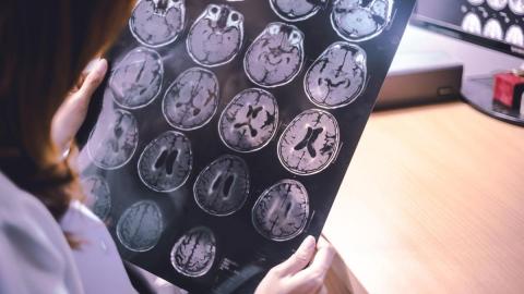 An approved new treatment slows the progress of Alzheimer's — but will provincial drug plans offer it?