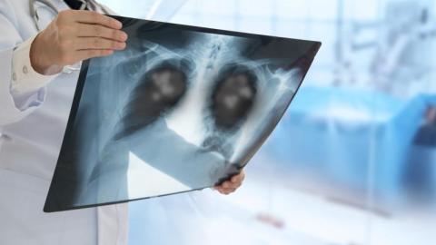 Antibiotic resistance threatens 30-year decline in deaths from lower respiratory infections