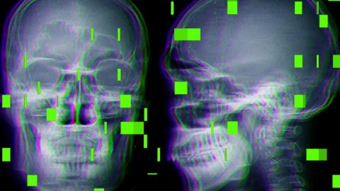 As AI enters the operating room, reports arise of botched surgeries and misidentified body parts