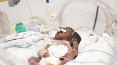 Babies with COVID-19 develop more serious disease than those with RSV, US data reveal