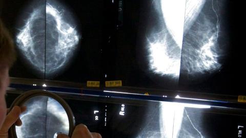 Black women face up to 70 per cent higher breast cancer mortality, study finds