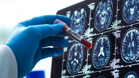 Blood Tests for Alzheimer's Are Here