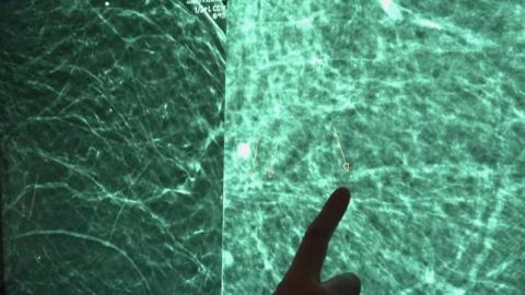 Can a mammogram help identify heart disease?