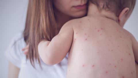 Canada lost its measles-free status. Our children deserve better