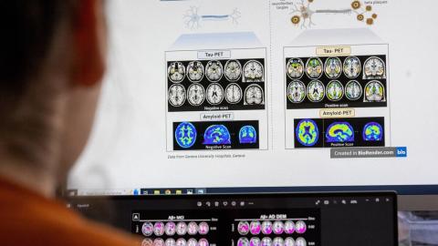 Canada's Drug Agency reverses course, now recommends public drug plans cover Alzheimer's drug