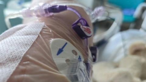 Canadian seniors struggle to recover post-surgery: study